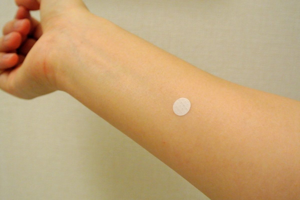 パッチテストをしている腕のイメージ