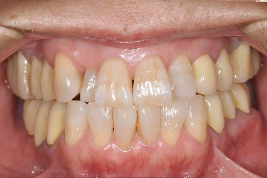 正面から見ても銀歯にかぶせものが無くなった口腔内
