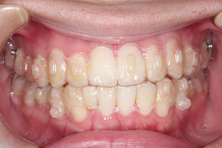 マウスピース型の矯正装置がはまった正面からみた口腔内
