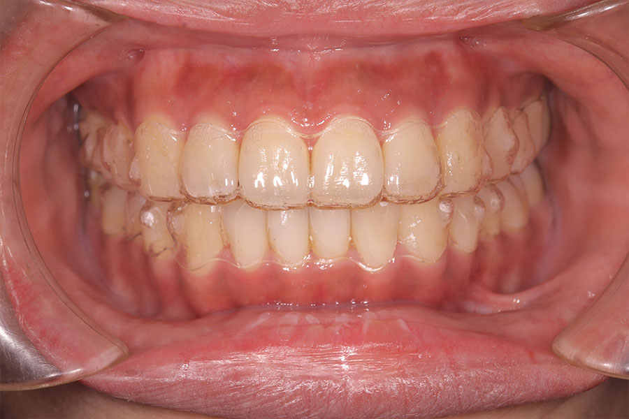 メタルフリーのインビザラインによる矯正装置が入った口腔内