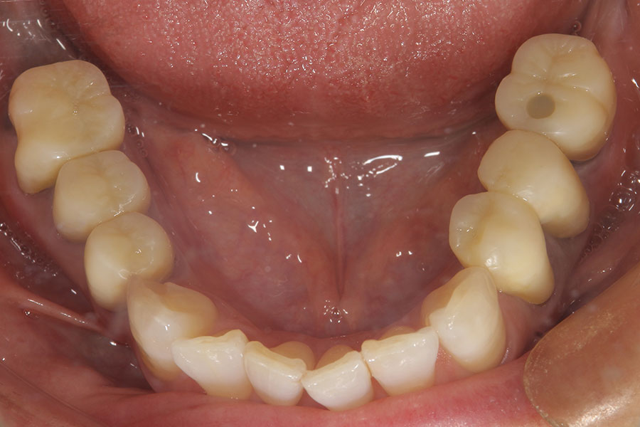 銀歯のかぶせものが無くなった下顎の口腔内