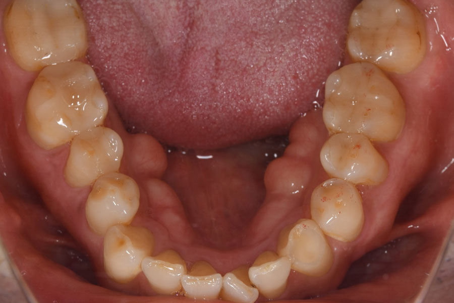 銀歯の詰め物が無くなった下顎の口腔内