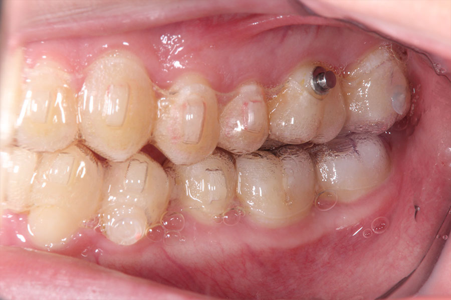 マウスピース型の矯正装置がはまった側面からみた口腔内