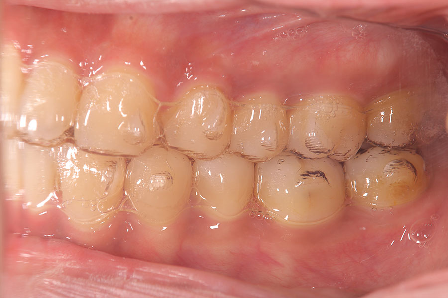 メタルフリーのインビザラインによる矯正装置が入った側面の口腔内