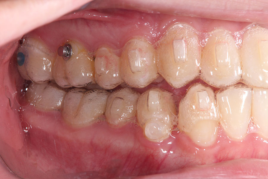 マウスピース型の矯正装置がはまった反対の側面からみた口腔内