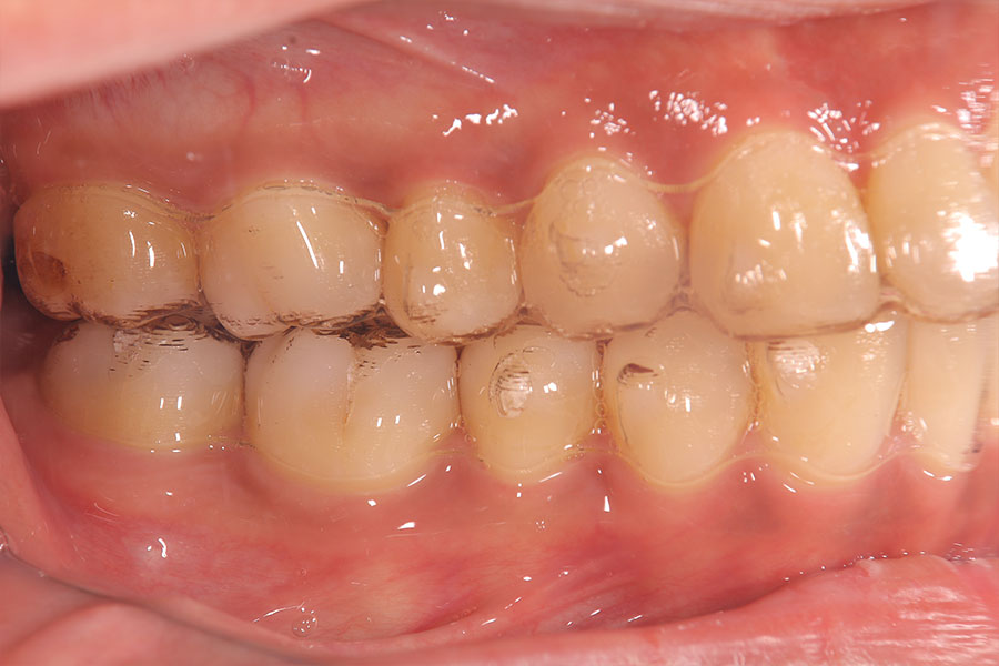 メタルフリーのインビザラインによる矯正装置が入った反対側面の口腔内