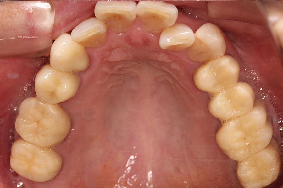 銀歯のかぶせものが無くなった上顎の口腔内