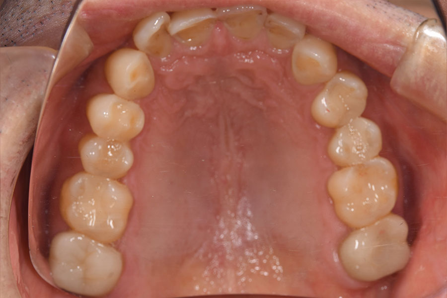 銀歯の詰め物が無くなった上顎の口腔内
