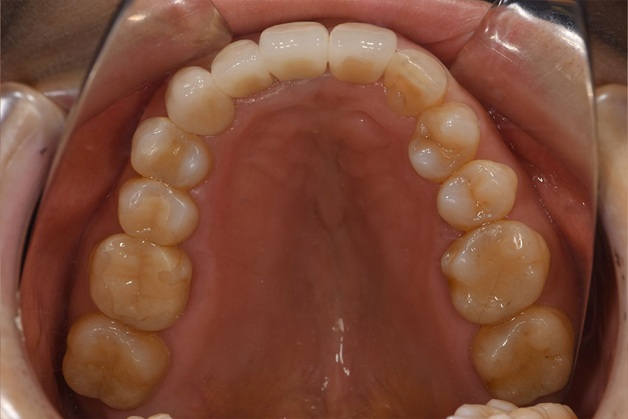 白くきれいな上顎の口腔内