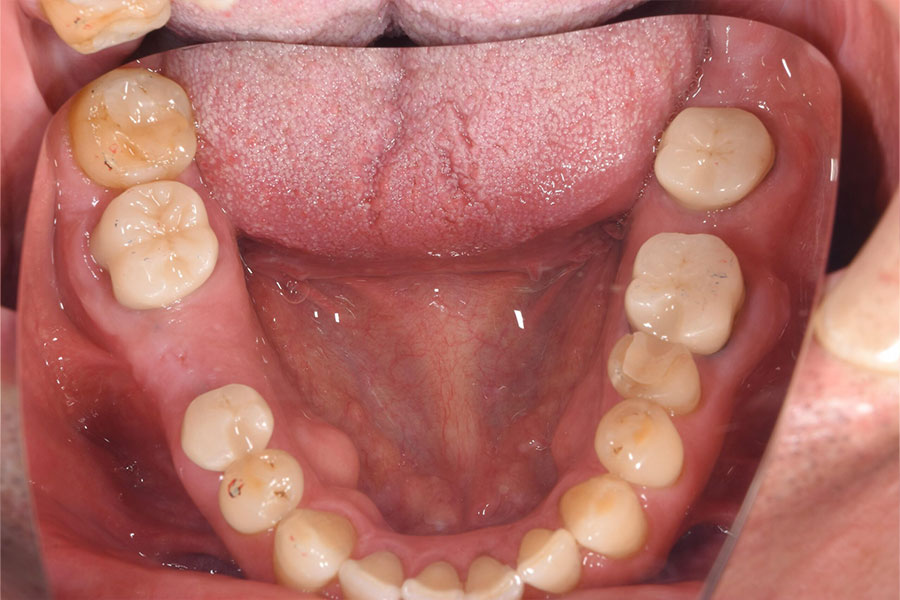 口腔内にアレルギー反応のあった患者さんの金属がなくなった口腔内