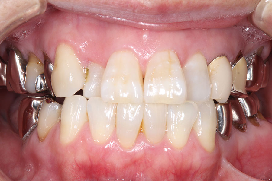 正面から見ても銀歯のかぶせものが見える口腔内
