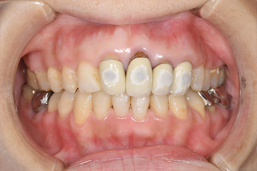 銀歯の詰め物や傷んだかぶせものが並ぶ正面からみた口腔内