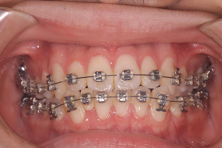 金属ワイヤーの矯正装置が付いている正面からみた口腔内