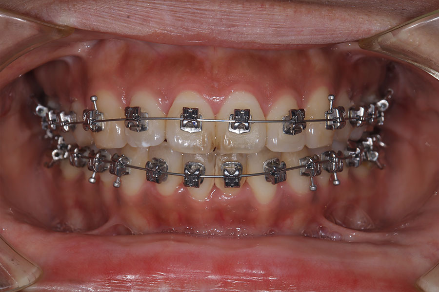 金属ワイヤーの矯正装置が付いている正面からみた口腔内