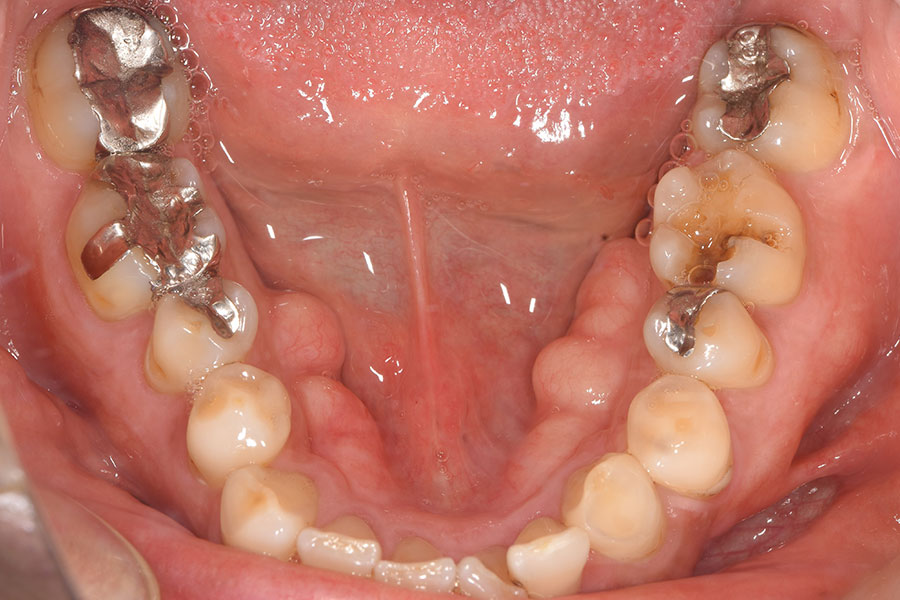 銀歯の詰め物が入っている下顎の口腔内