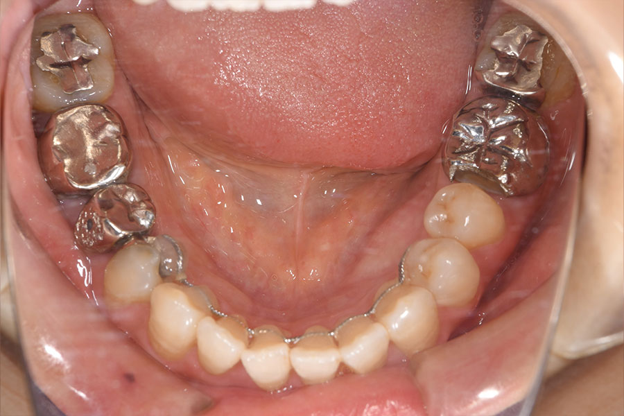 銀歯の詰め物とかぶせものが並ぶ下顎の口腔内