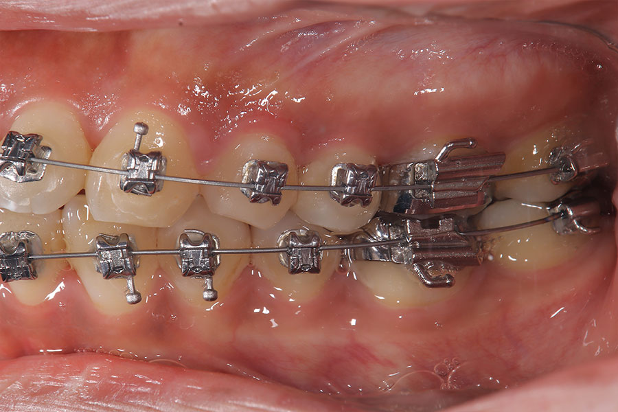 金属ワイヤーの矯正装置が付いている側面の口腔内