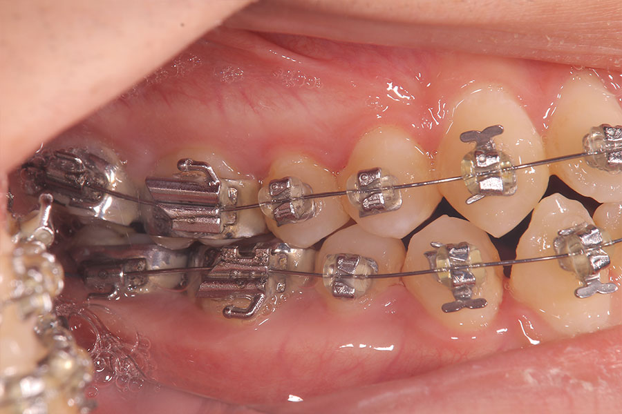 金属ワイヤーの矯正装置が付いている反対の側面からみた口腔内