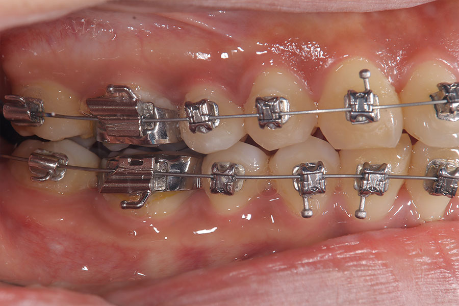 金属ワイヤーの矯正装置が付いている反対側面の口腔内