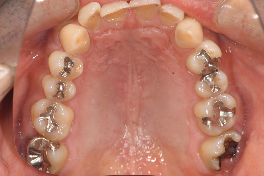 銀歯の詰め物が入っている上顎の口腔内