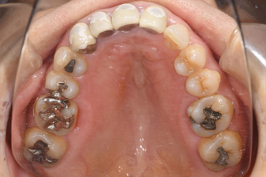 銀歯の詰め物と前歯の保険適用のかぶせものが並ぶ上顎の口腔内