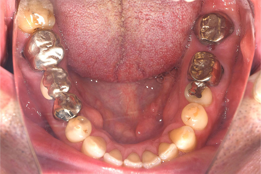 口腔内にアレルギー反応のあった患者さんの金属が入った口腔内