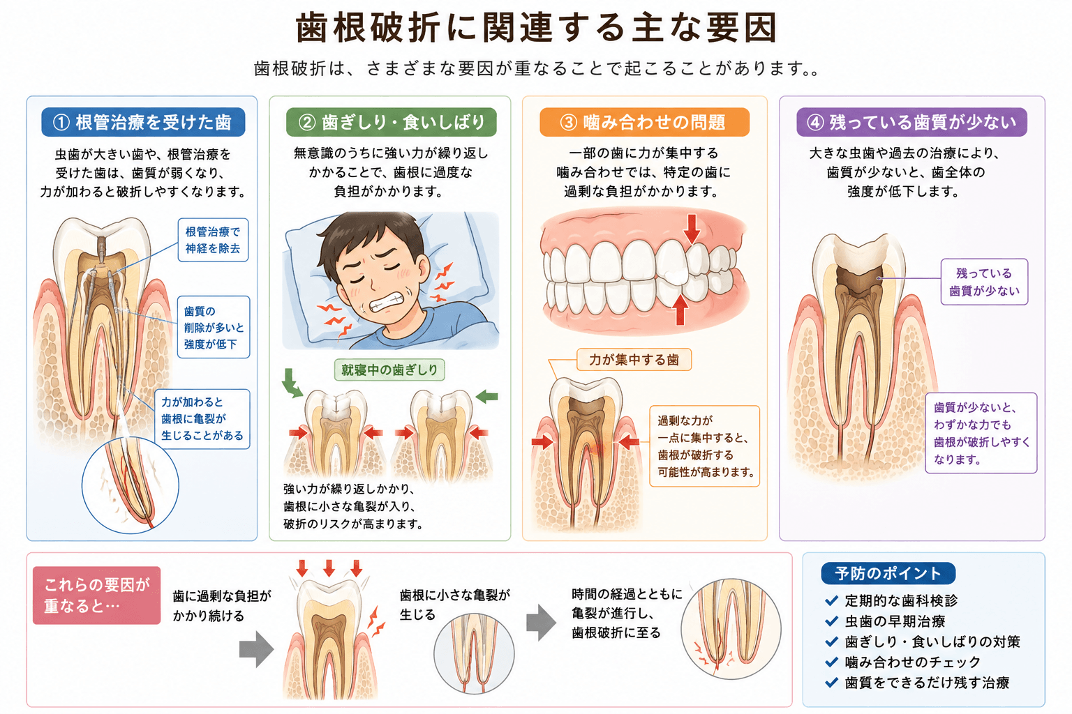 歯根破折に関連する主な要因。歯ぎしり、食いしばり、硬い物、残存歯質、土台や被せ物などを示したイラスト