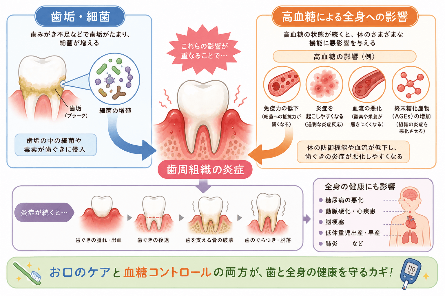 歯垢や細菌による刺激と高血糖による全身状態の変化が歯周組織の炎症に関係する仕組みを示す図