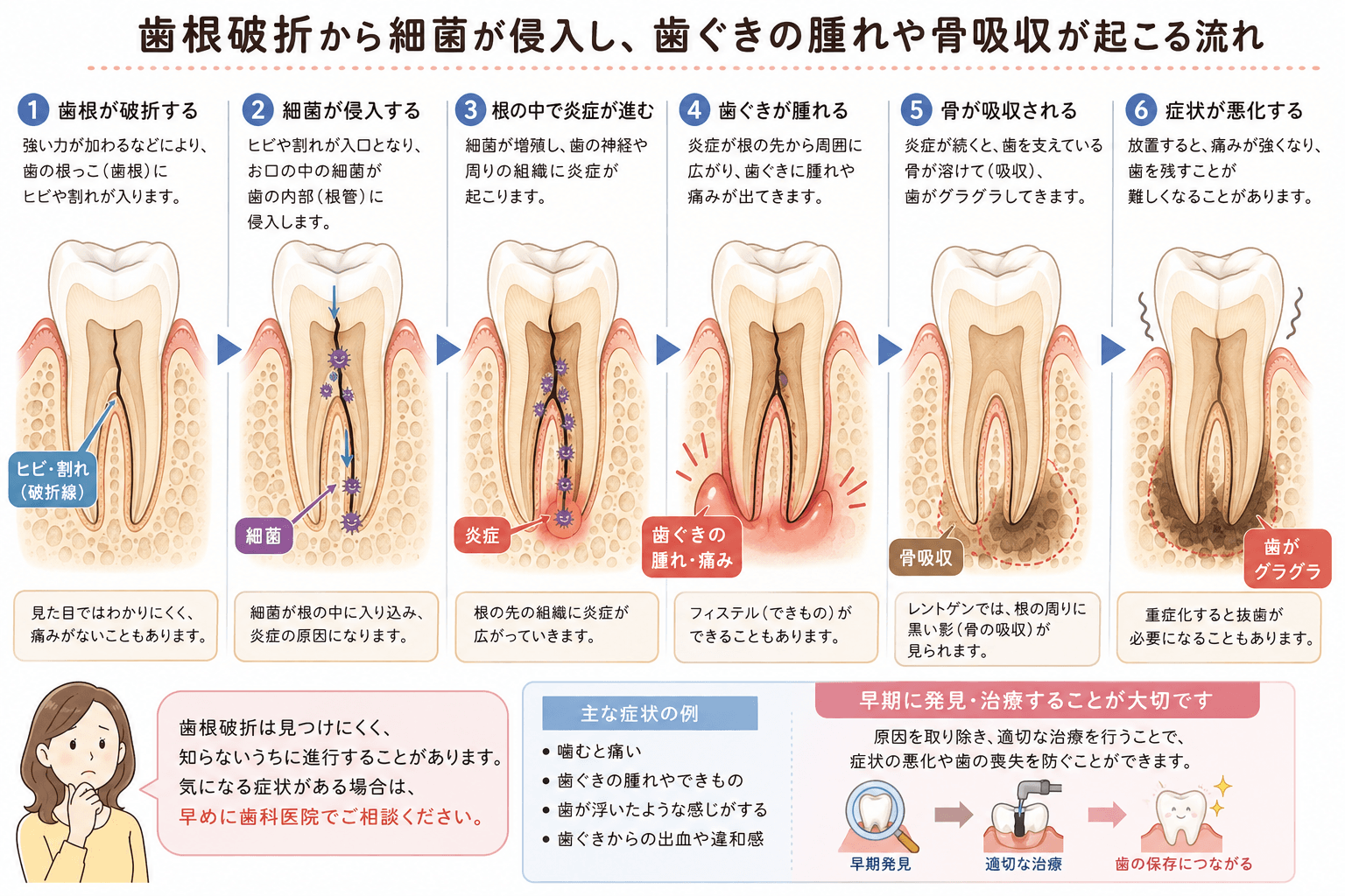歯根破折でみられる噛むと痛い、歯ぐきの腫れ、膿、歯の揺れなどの主な症状を示すイラスト