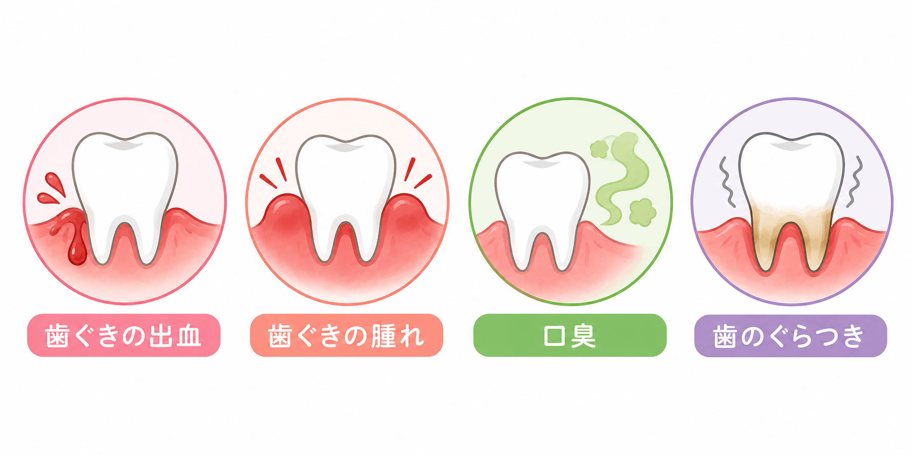 歯ぐきの出血・歯ぐきの腫れ・口臭・歯のぐらつきなど歯周病で気づきやすい症状を示すイラスト