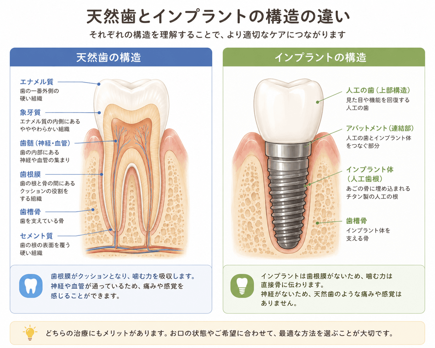 天然歯とインプラントの断面構造を比較したイラスト