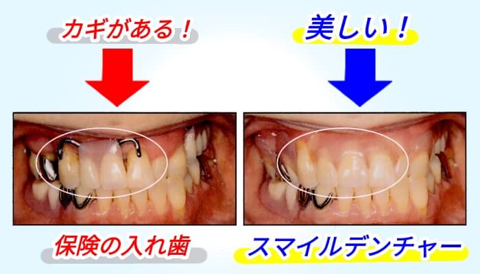 スマイルデンチャー前歯