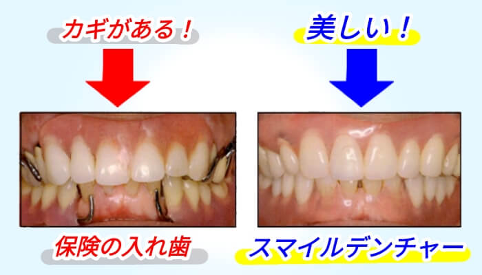 スマイルデンチャー前歯と奥歯