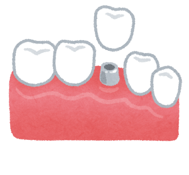 インプラントのイラスト（歯の治療） | かわいいフリー素材集 いらすとや